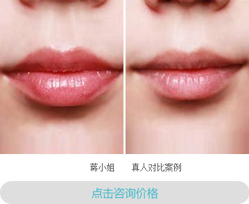 激光洗唇线 丰润美唇更性感
