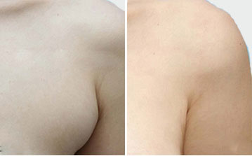 副乳切除